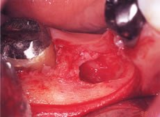 (1) 右下の奥歯を抜歯した後の穴