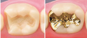 虫歯を削り（左）インレーで塞ぐ（右）